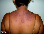 erythema multiforme