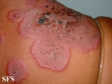 erythema multiforme