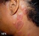 erythema multiforme
