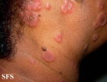 erythema multiforme