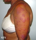erythema multiforme