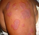 erythema multiforme