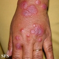 erythema multiforme