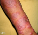 erythema multiforme