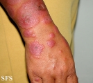 erythema multiforme