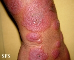 erythema multiforme