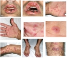 erythema multiforme