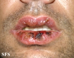erythema multiforme