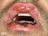 erythema multiforme