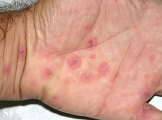 erythema multiforme