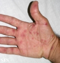 erythema multiforme