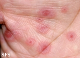 erythema multiforme