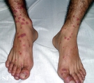 erythema multiforme