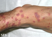 erythema multiforme