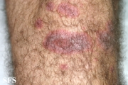 erythema multiforme