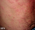 anetoderma jadassohn pellizari