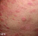 anetoderma jadassohn pellizari