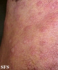 anetoderma jadassohn pellizari