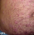 anetoderma jadassohn pellizari