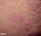 anetoderma jadassohn pellizari