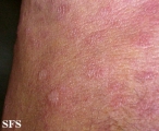 anetoderma jadassohn pellizari