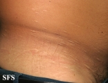 anetoderma jadassohn pellizari