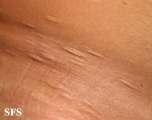 anetoderma jadassohn pellizari