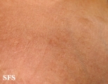 anetoderma jadassohn pellizari