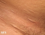 anetoderma jadassohn pellizari