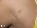 anetoderma jadassohn pellizari