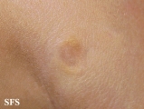 anetoderma jadassohn pellizari