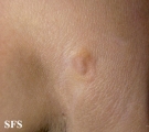 anetoderma jadassohn pellizari