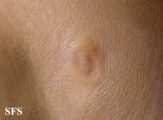 anetoderma jadassohn pellizari