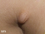 anetoderma jadassohn pellizari