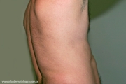 anetoderma jadassohn pellizari