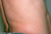 anetoderma jadassohn pellizari