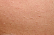 anetoderma jadassohn pellizari