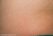 anetoderma jadassohn pellizari