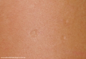 anetoderma jadassohn pellizari