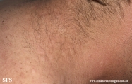 anetoderma jadassohn pellizari