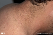 anetoderma jadassohn pellizari