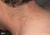 anetoderma jadassohn pellizari