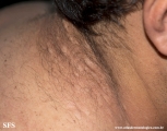 anetoderma jadassohn pellizari