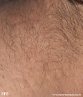 anetoderma jadassohn pellizari