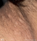 anetoderma jadassohn pellizari