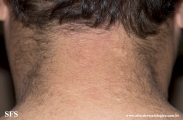 anetoderma jadassohn pellizari
