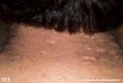 anetoderma jadassohn pellizari