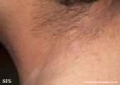 anetoderma jadassohn pellizari