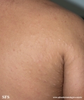 anetoderma jadassohn pellizari