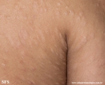 anetoderma jadassohn pellizari